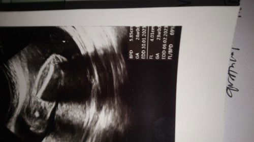 Tentang tulang paha janin