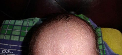 Bayi 12 hari muncul bintik di jidat sampai kepalanya