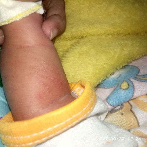 Bintik bintik pada bayi 1 minggu