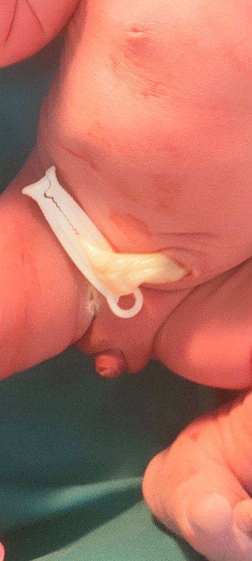 Mga mamzh meron po ba gnito case ng baby dito??