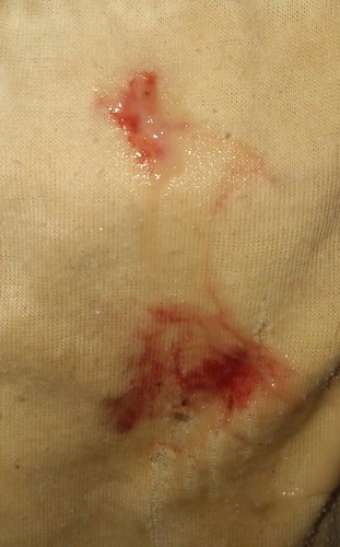 Mucus plug?