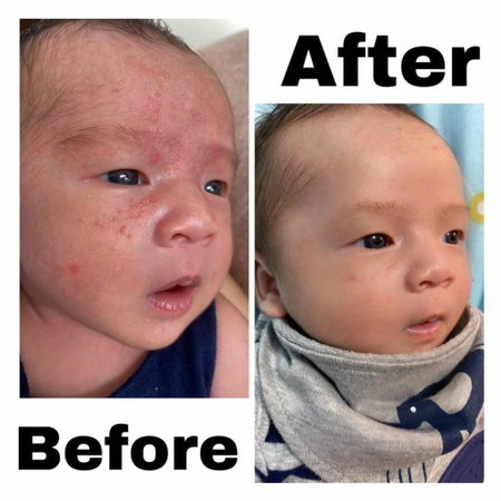 Mustela Cicastela for baby Acne update