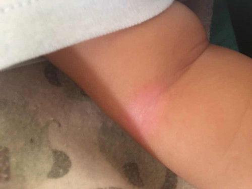 Redness, dry skin, itchiness