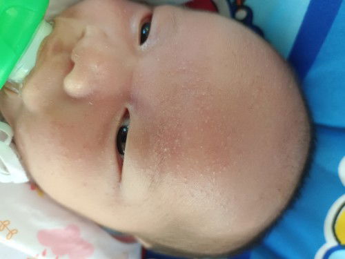 สอบถามแม่ๆหน่อยค่ะน้องเป็นผดผื่นที่หน้าต้องใช้อะไรค่ะถึงจะหายขึ้นแต่ที่หน้าค่ะตามตัวไม่มี