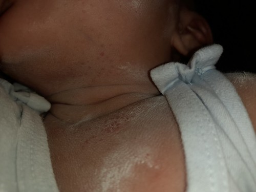 Pula pula sa leeg ni baby