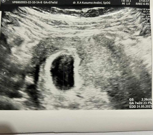 Usg 7w2d baru terlihat yolk sac