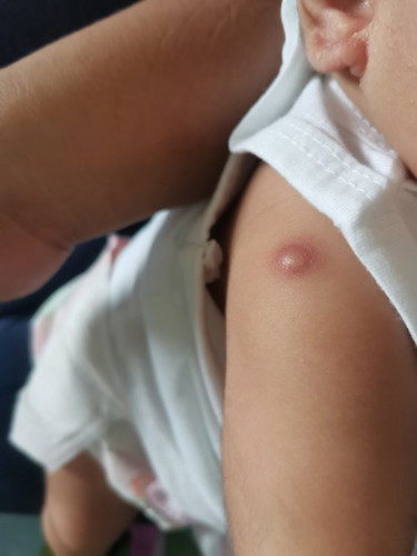 may maliit na bukol si baby sa kanang balikat, mejo matigas po ito tska di nmn po nasasaktan si baba