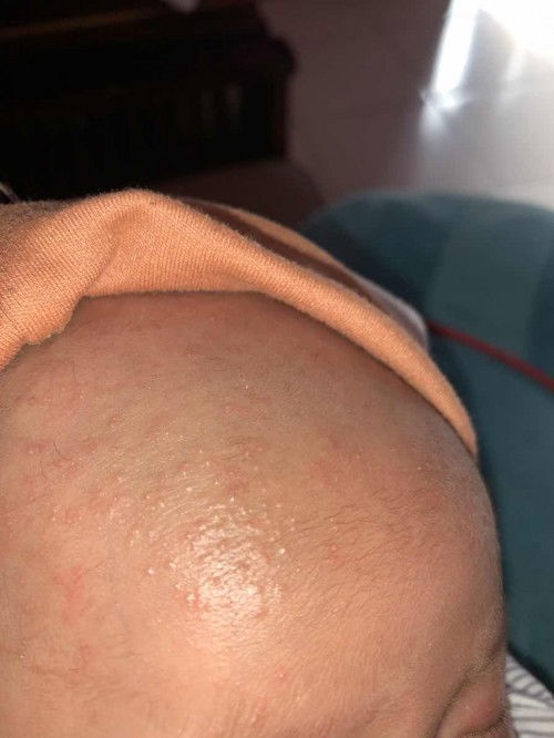 Bintik merah di bayi 1 bulan