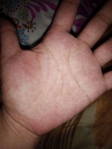 Mga mommy tanong ko lang baka alam nyo kung ano po itong parang mga pantal pantal sa kamay ko