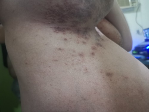 PUPPP/ Rash