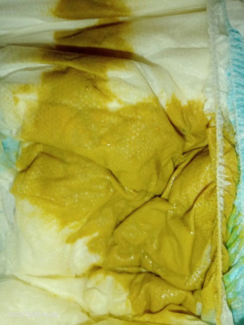 Pasintabi po ask lang po bkait po kaya ganito poop n baby ngaun..2monthsold po..3days na po now...