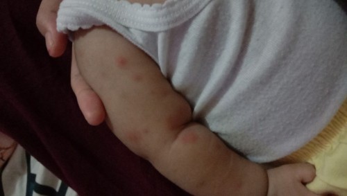 Obat gatal dan merah pada bayi bagaimana ya cara pengobatannya