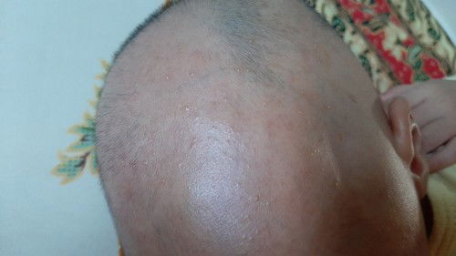 Muncul bintik² merah di kepala setelah cukur