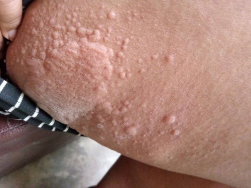 ผื่นคันตามตัว