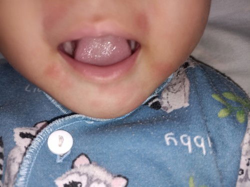 Sekitar bibir merah setelah mpasi