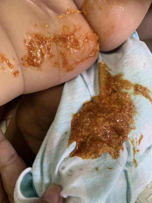 ลูกถ่ายแบบนี้ผิดปกติมั้ยคะเป็นมา3วันแล้วช่วยแนะนำหน่อยค่ะแม่ๆๆ