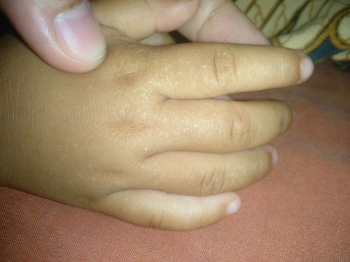 Bintil bintil kecil di jari sampai ketangan