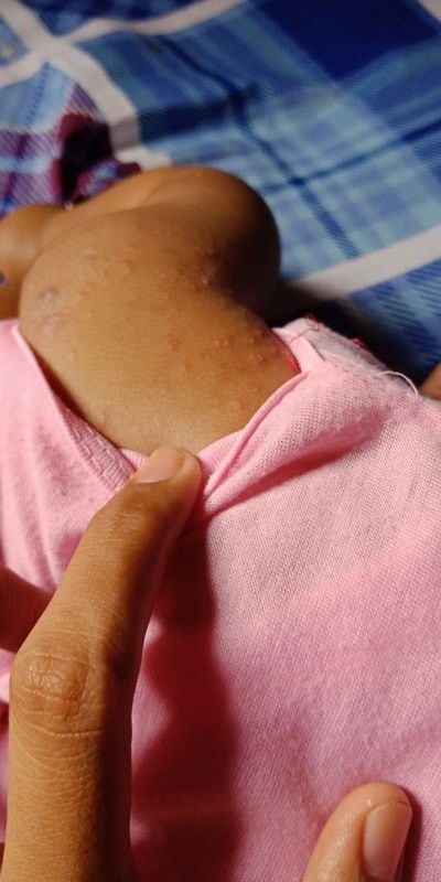 Calicil untuk obati beruntusan