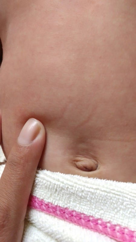 Benjolan diatas pusar bayi