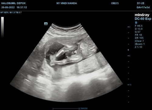 Jenis kelamin bayi emg bisa berubah?