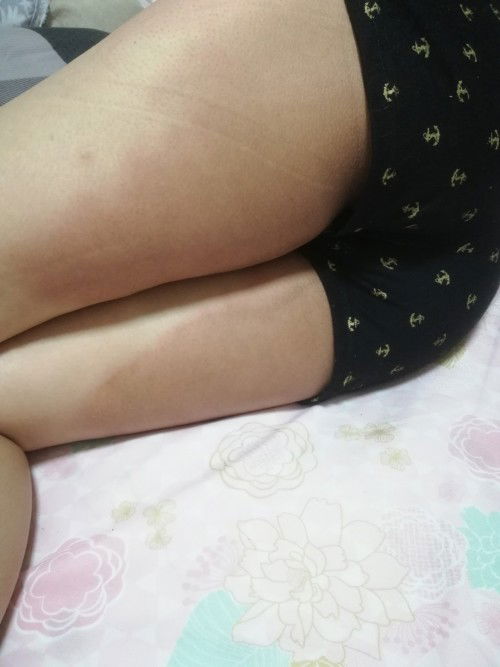 มีแม่ๆท่านไหนเป็นรอยแดงรอยแตกหลังต้นขาบ้างมั้ยค่ะ