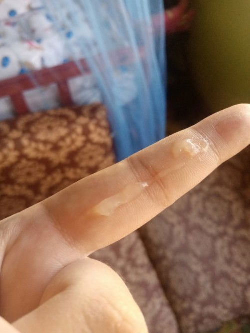 Pasintabi po sa pic mga mamsh... ❤️
Mucus plug na po ba ito?
37 weeks pregnant na po❤️