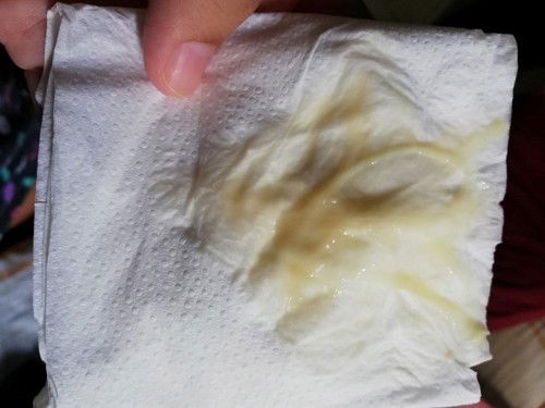 Vaginal discharge/bacterial infection