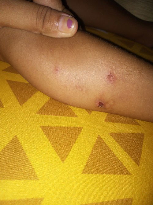 Anak saya 2th suka gatal"