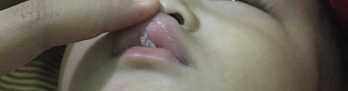 Bibir atas bercam putih