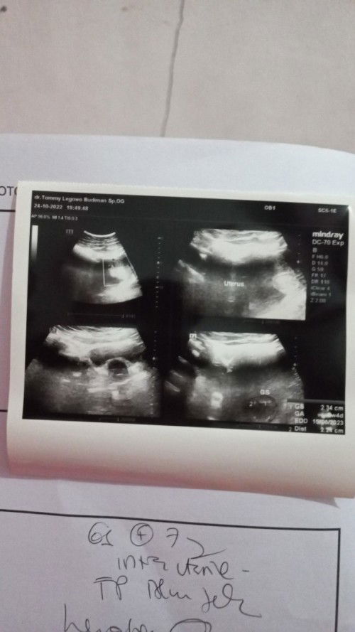 JANIN HILANG SAAT USG KE 2 PADA USIA 12W