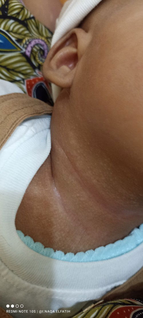 Putih2 dileher , dimuka dan diarea tubuh lain nya