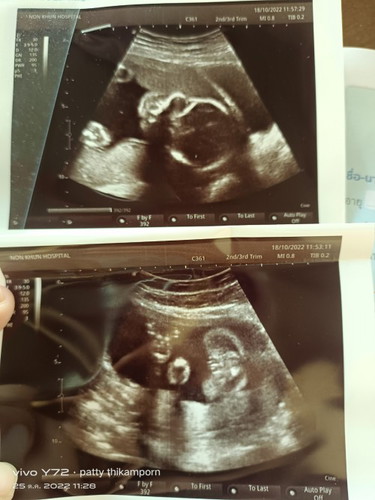 แม่ๆช่วยดูหน่อยจ้า ดูยังไงให้น้องเป็นผู้หญิง หมอบอกผู้หญิง80% รอซาวด์อีกที31นี้