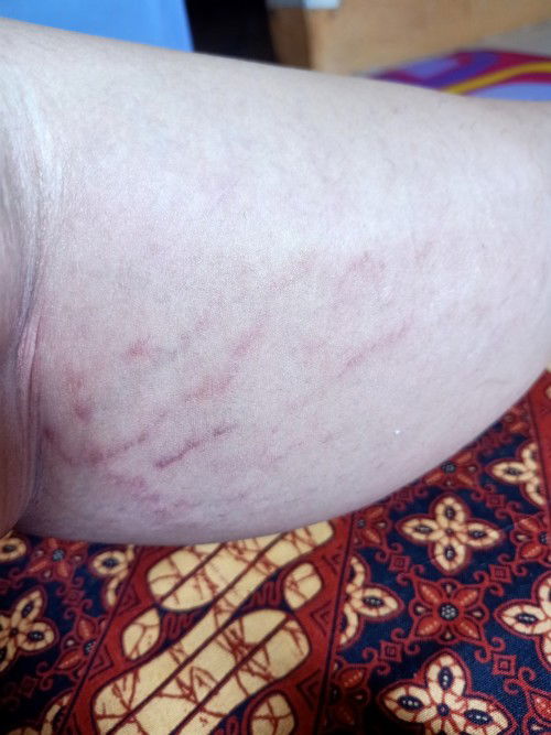 Pembuluh darah di betis