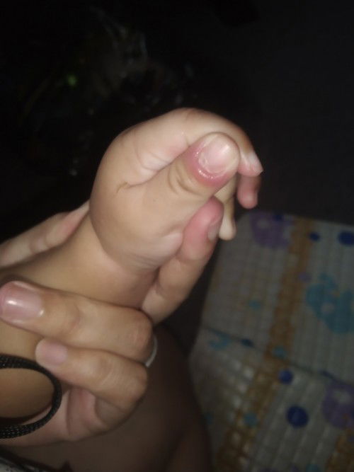 Jari jempol bengkak dibagian kuku"