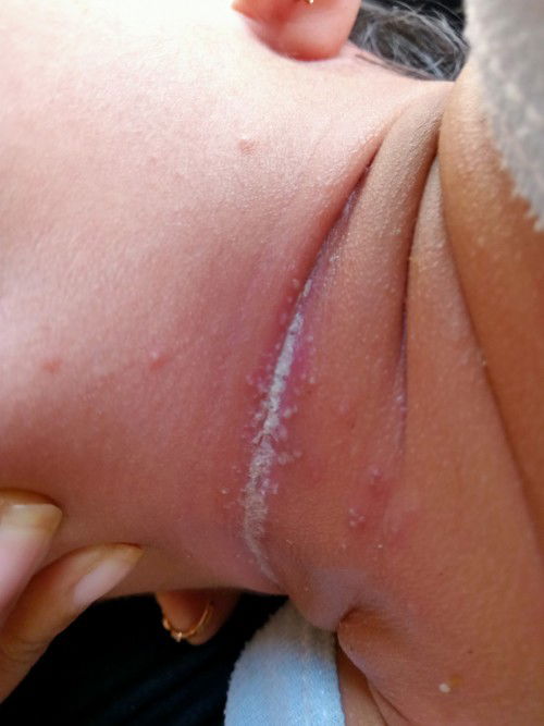 Bintik merah dibagian leher,dan anak sering BAB