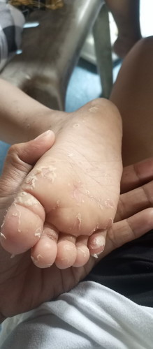 hello po mga momshies!👋
tatlong taon na po ang anak ko..bakit po kaya nagbabalat ang paa ng anak ko