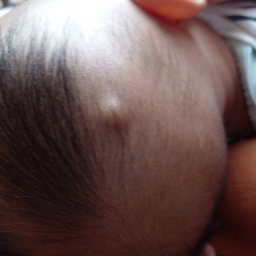 Anak saya ko ada benjolan di kepala tp itu dr lahir bahaya apa tidak ya bun mhon solusinya