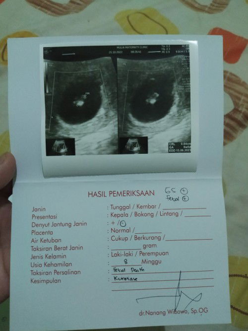 Denyut jantung janin tidak ada , janin tidak berkembang