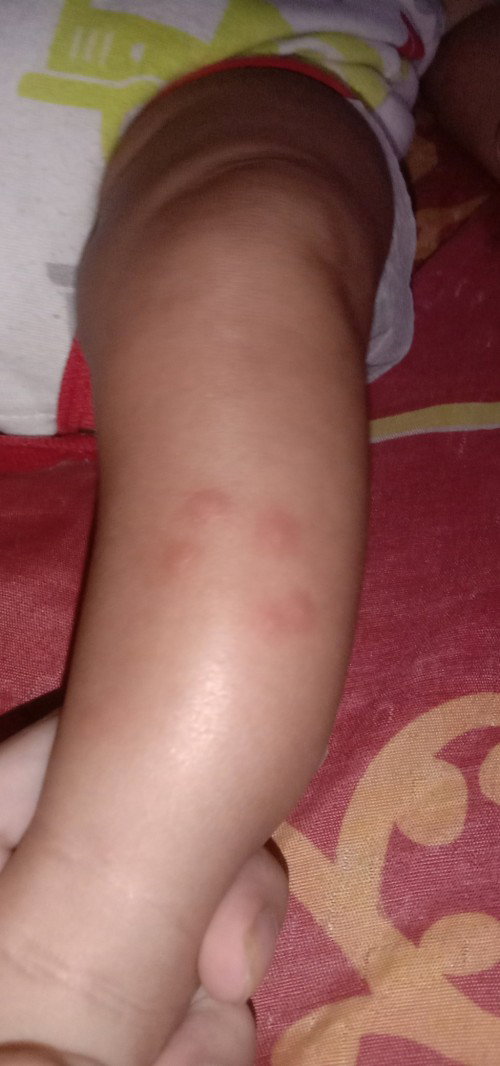 Bendol pada bayi