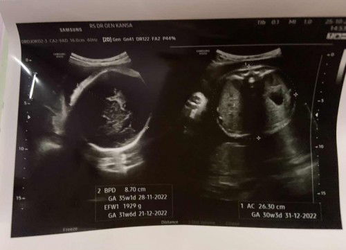 Hasil USG Lingkar Perut Janin kurang 2minggu dari usia kehamilan