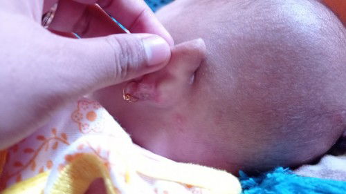 Biang keringat berair