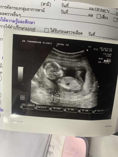 อายุครรภ์15w หมอบอกหัวน้องเล็ก