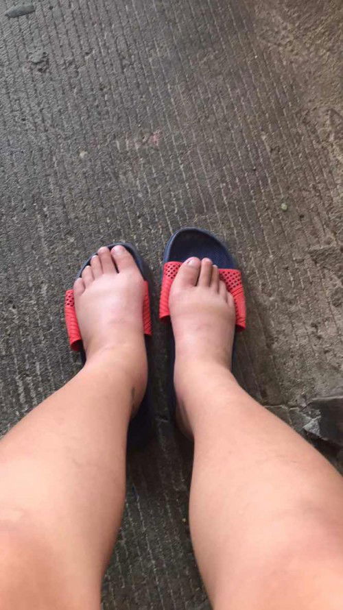 บวมแบบนี้จะเป็นอะไรไหมค้า