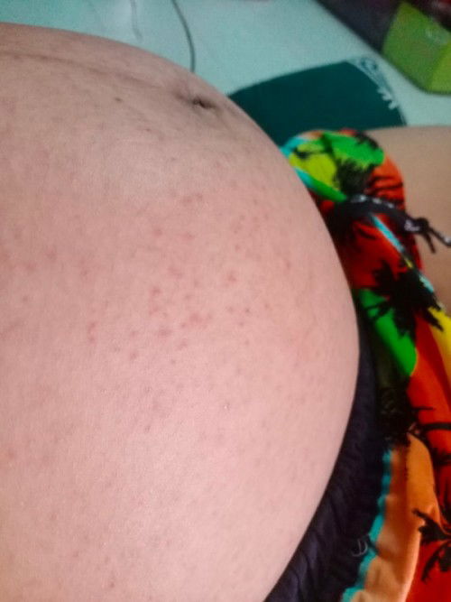 ท้องเป็นจุดแดงแบบนี้คืออะไรค่ะ