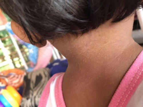 ตุ่มตรงคอกับข้อพับแขน