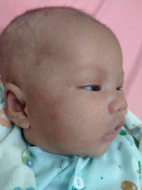 bintik-bintik merah pada pipi bayi