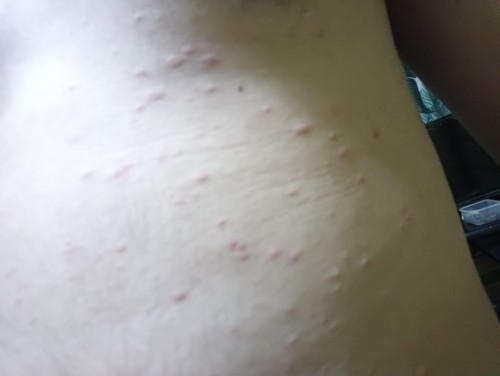 tigdas po ba or kati kati lang