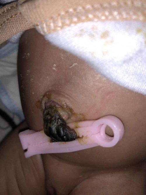 Tali pusar belum lepas