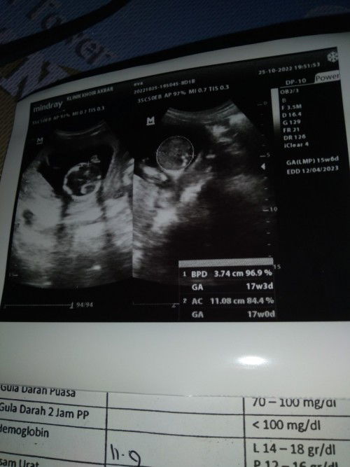 Hasil USG UK 16weeks