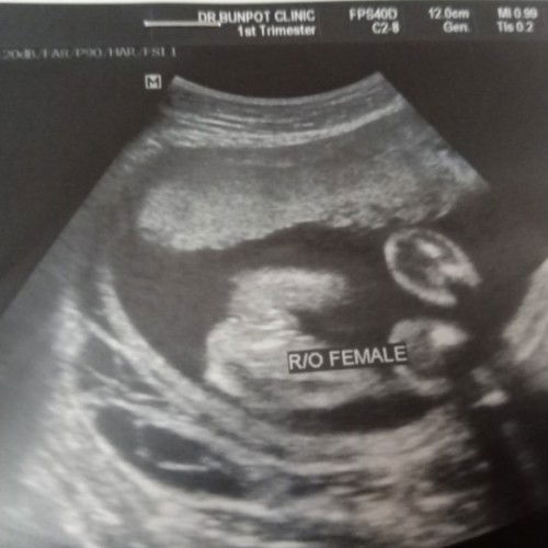 ภาพอัลตร้าซาวช่วยดูหน่อยจ้าว่าใข่เพศหญิงชัวๆเลยไหม 😀😀